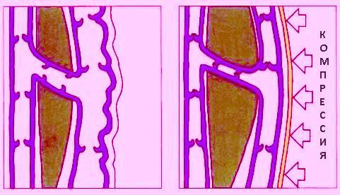 The action of compression hosiery